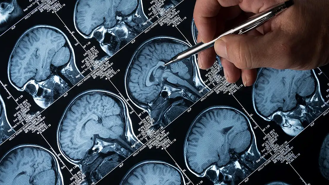 Alzheimer'a Karşı Umut Veren Gelişme: İki Kanser İlacı Beyindeki Hasarı Tersine Çevirdi